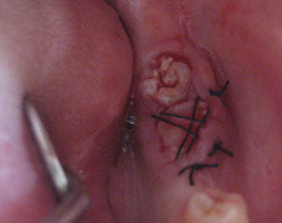 �������ȁE�C���v�����g���̂��������ȃN���j�b�N�]����